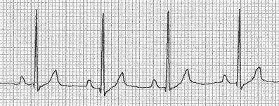 ECG